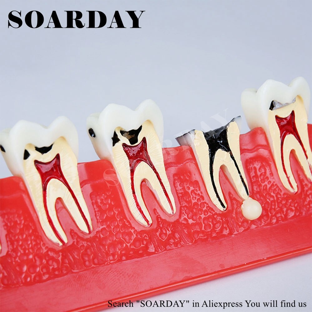 Caries Model Development