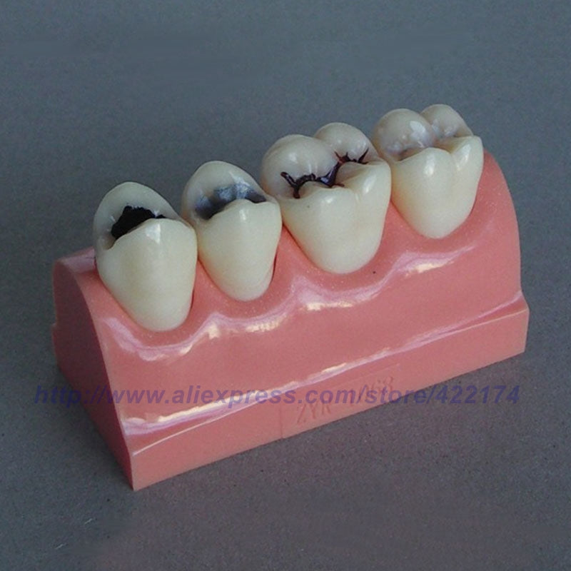 Caries treatment model