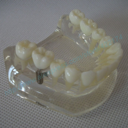 Free Shipping Implant