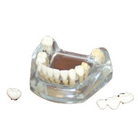 Free Shipping Implant