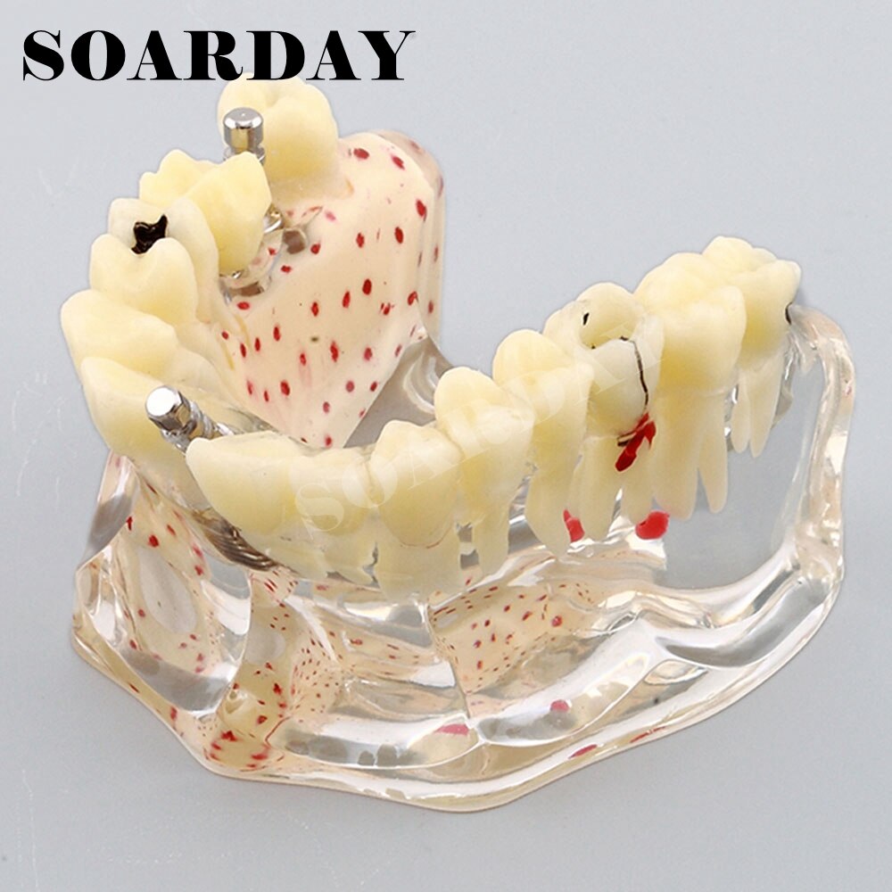 Implant Dental Model