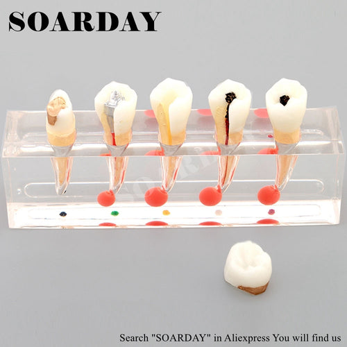 SOARDAY Endodontic Disease