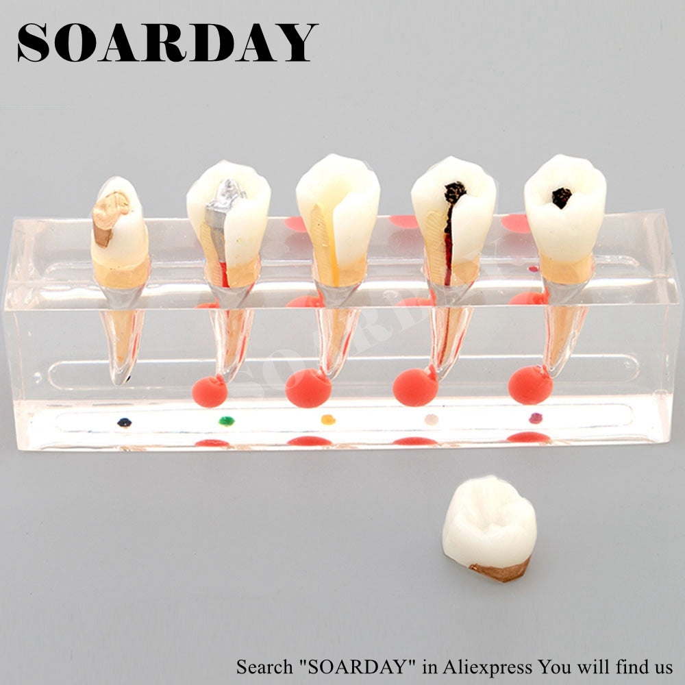 SOARDAY Endodontic Disease