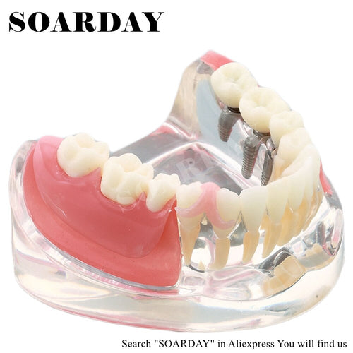 SOARDAY Implant &