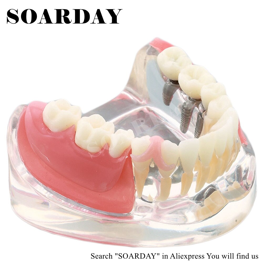 SOARDAY Implant &