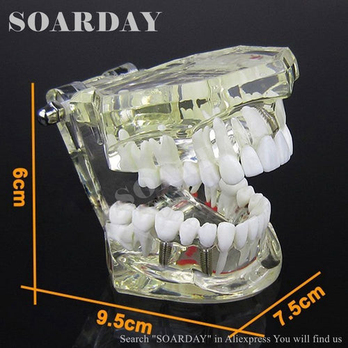 SOARDAY Implant model