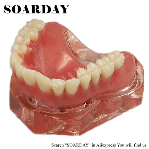 SOARDAY Overdenture inferior