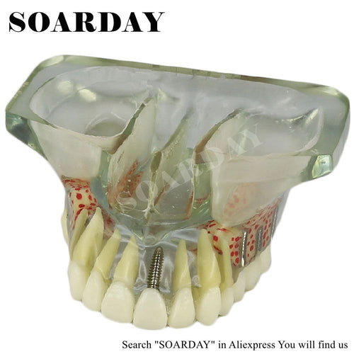 SOARDAY dental implant