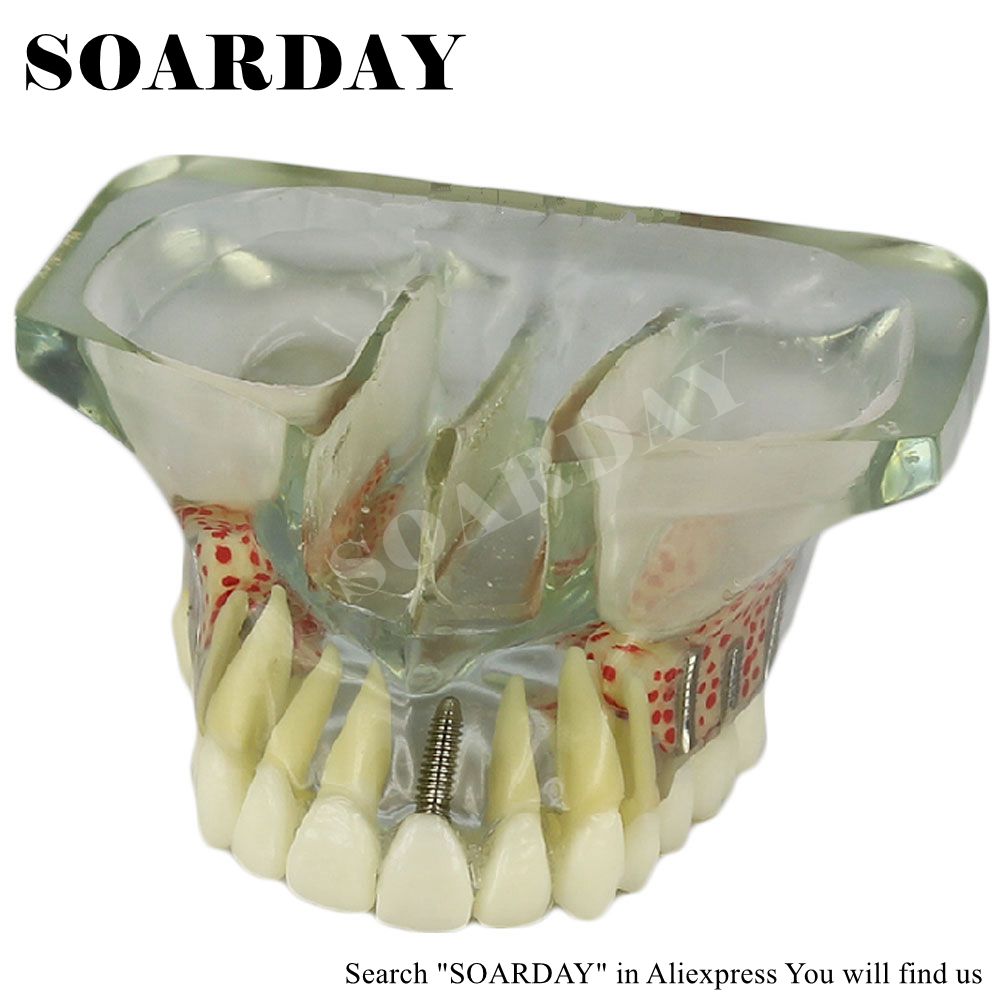 SOARDAY dental implant